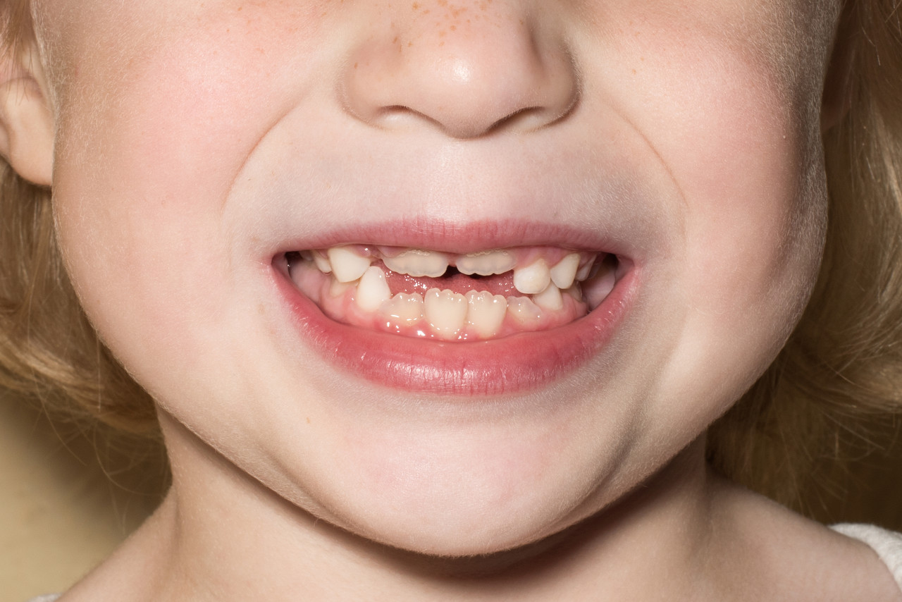 儿童牙颌畸形的几个不良习惯