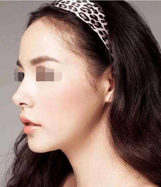 一个面部消瘦的姑娘却有一个大鼻头该怎么达到鼻面协调性