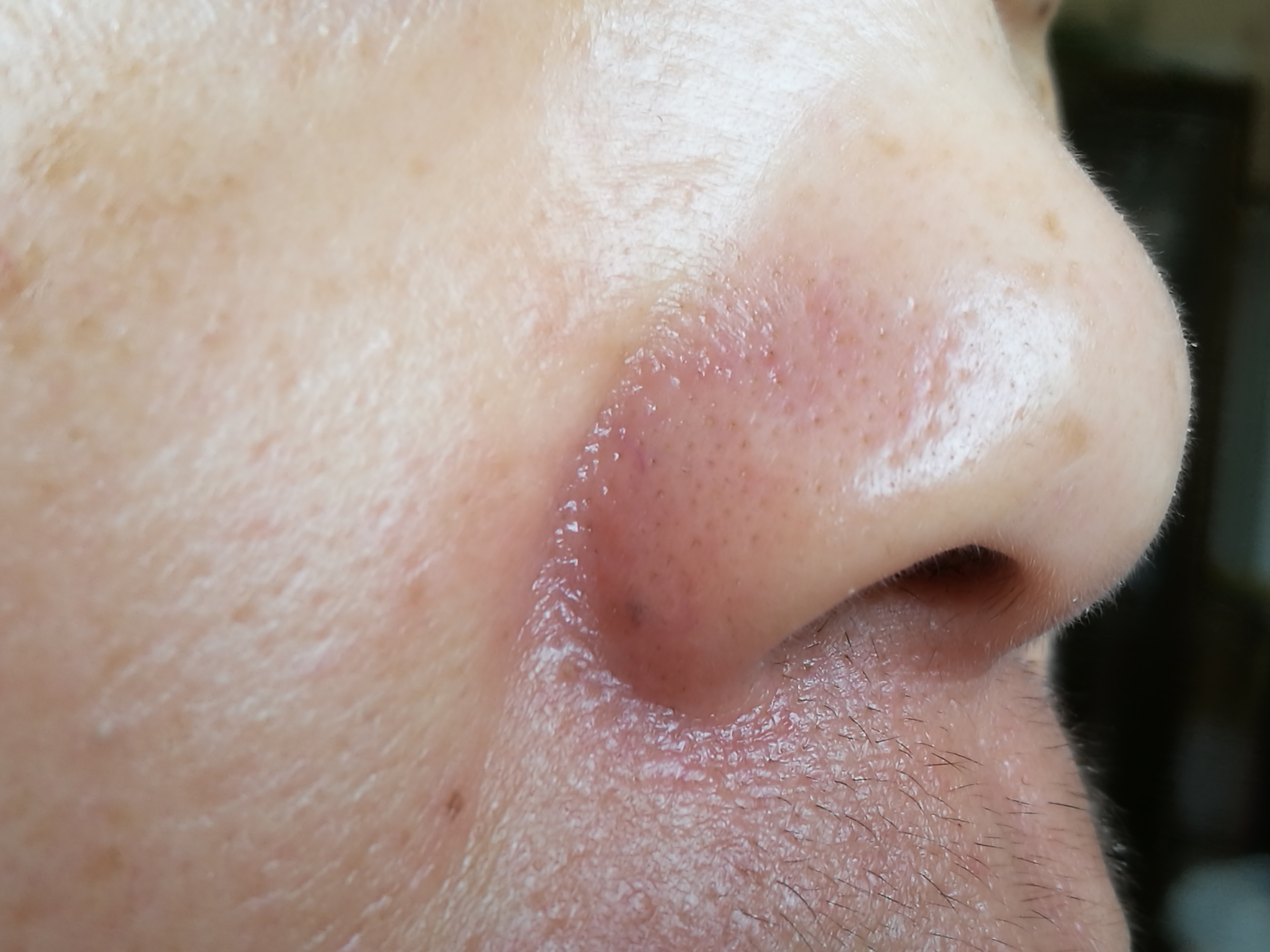 有“法令纹”或者“嘴凸”，就是鼻基底凹陷吗？3招帮你精准判断