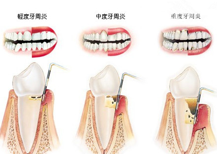 收藏贴牙周病治疗与预防