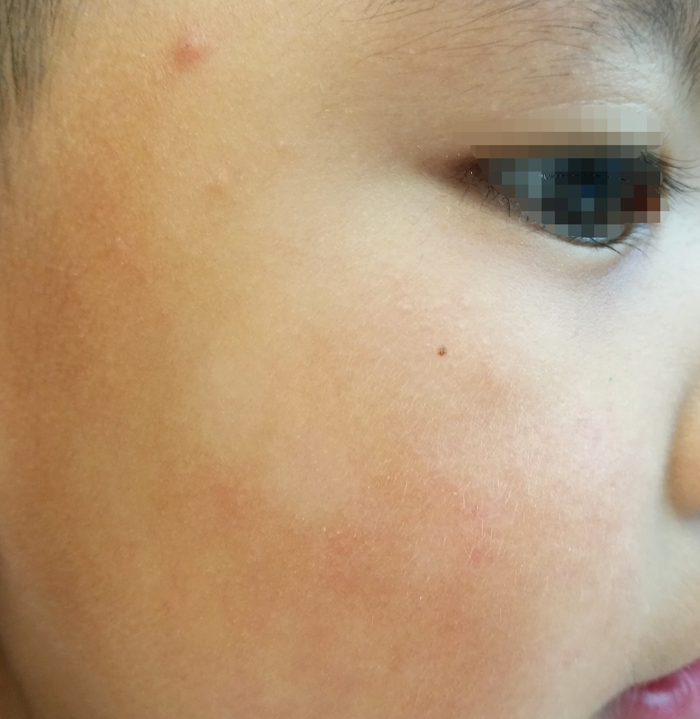 孩子脸上有虫斑图片图片