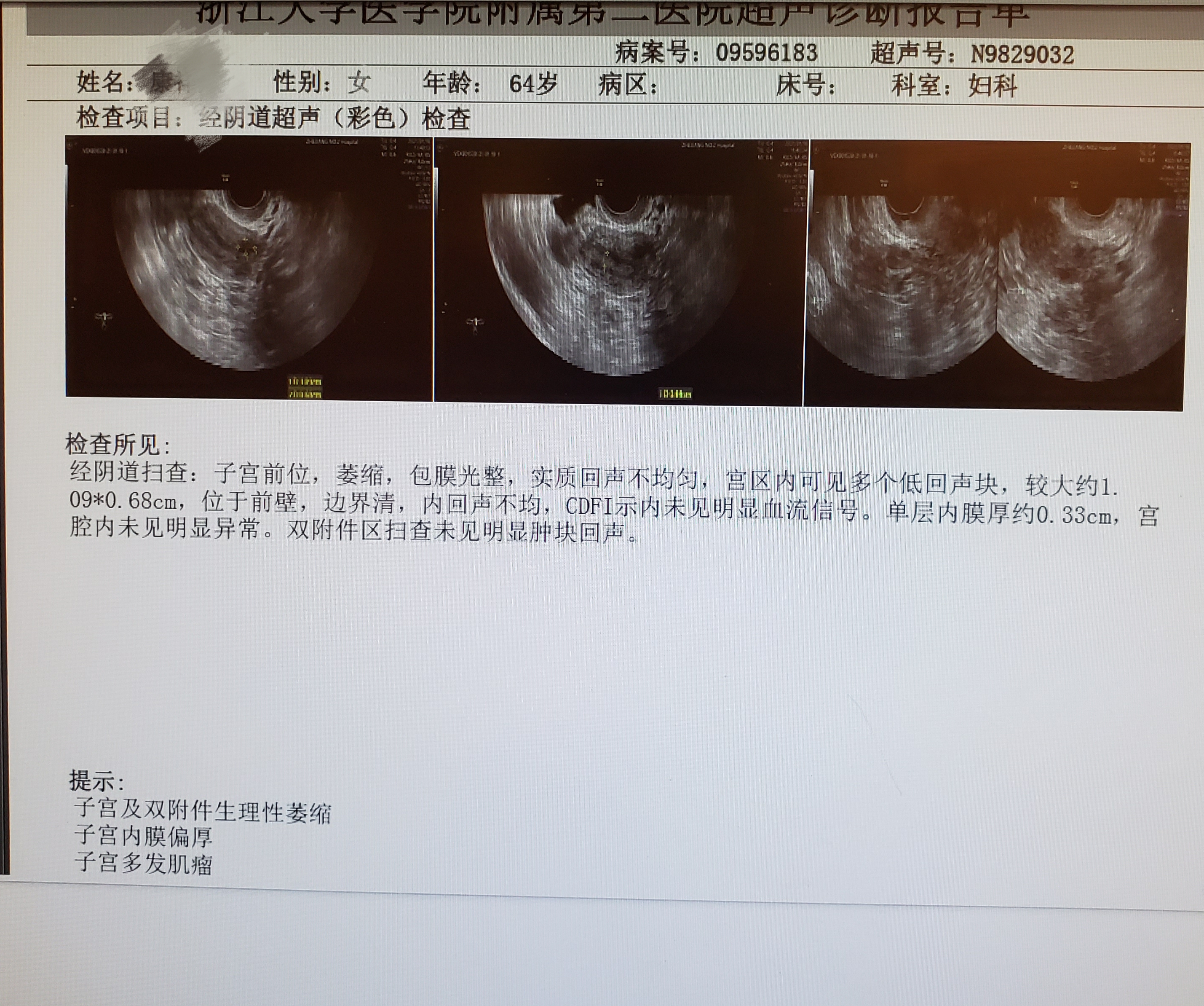 子宫内膜癌彩超图片