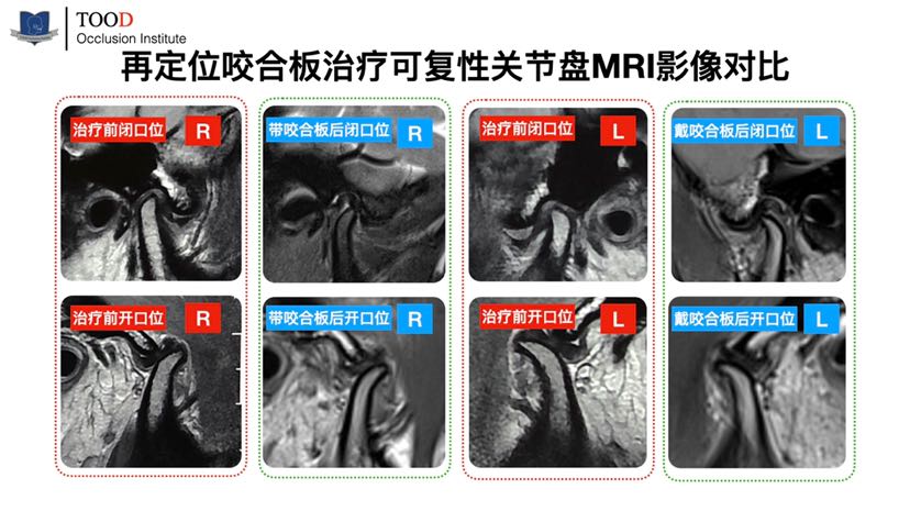 不能忽視的顳下頜關節彈響