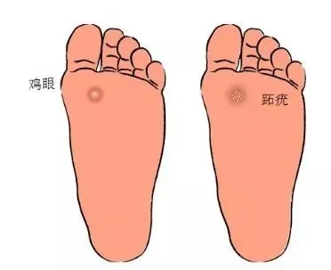 3,皮损不同:跖疣为黄豆大小或更大圆形或椭圆形灰黄角化斑块,表面粗糙