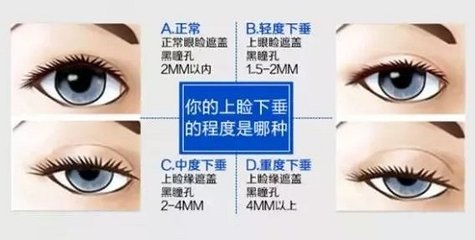 割双眼皮前要了解哪些细节?