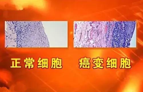 慢性炎症状气管支老年病变_老年性慢性支气管炎_老年慢性支气管炎的症状