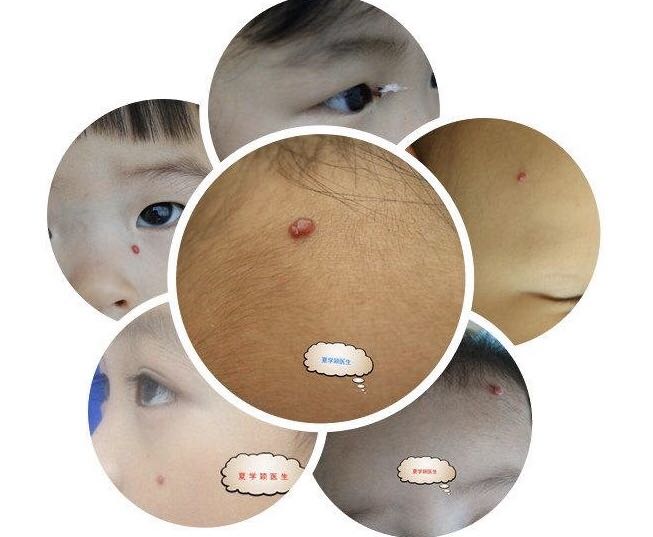 什么是化脓性肉芽肿?