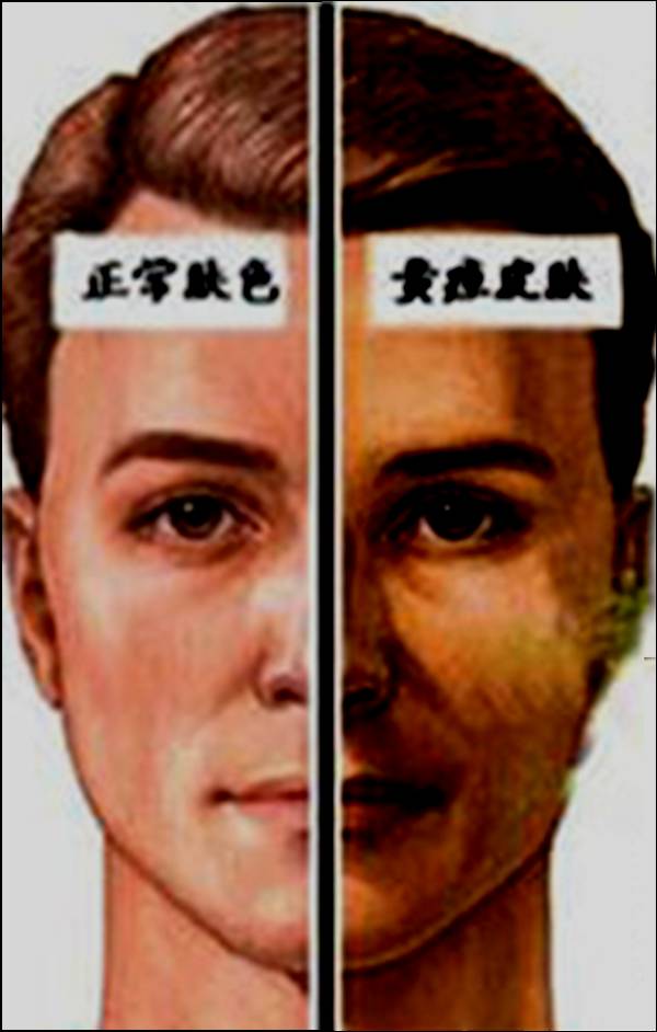 梗阻性黄疸的介入治疗