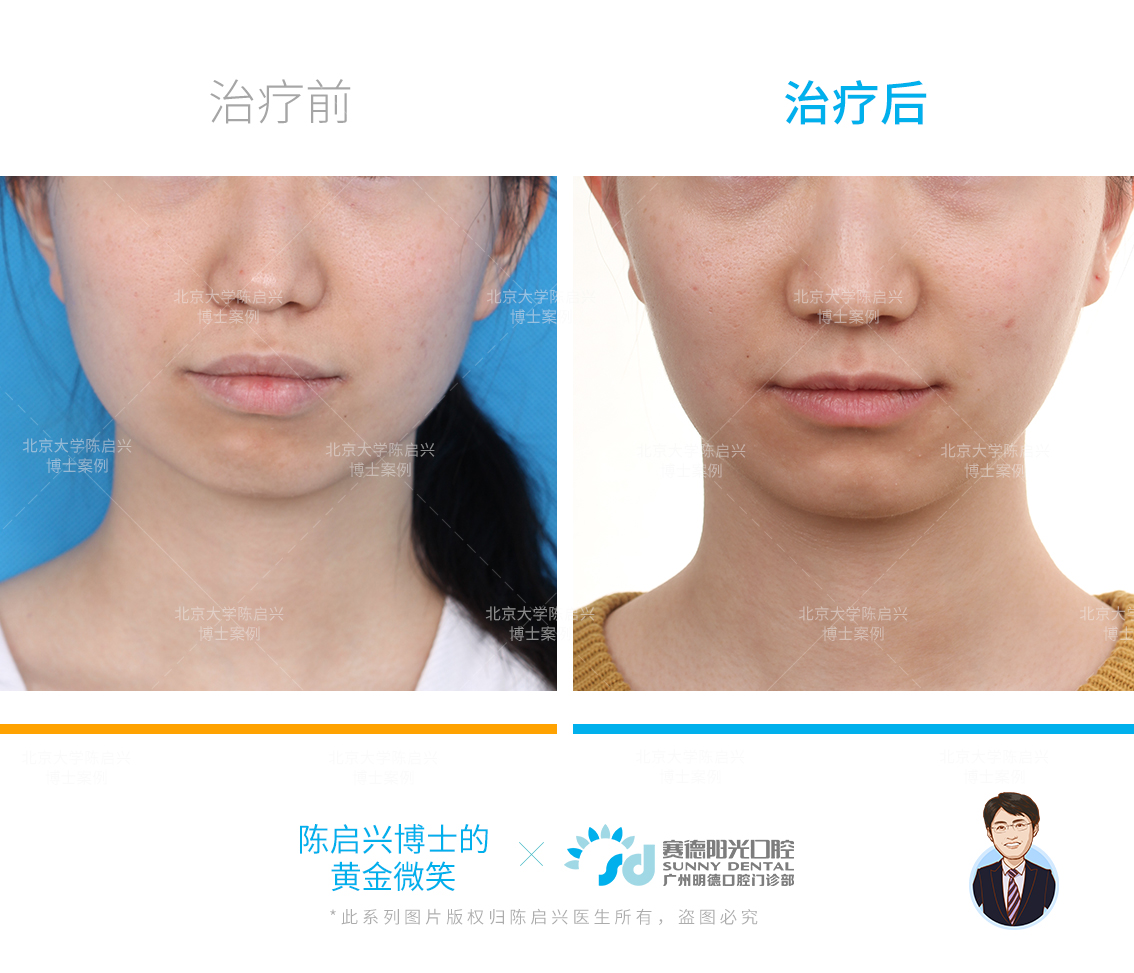 高角骨性下颌后缩矫正案例