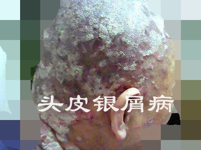 3,头皮银屑病2,石棉状糠疹1,脂溢性皮炎一,头皮屑原因比较多,常见的