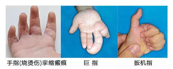 6根手指,手指相连,拇趾外翻……手足畸形怎么治?