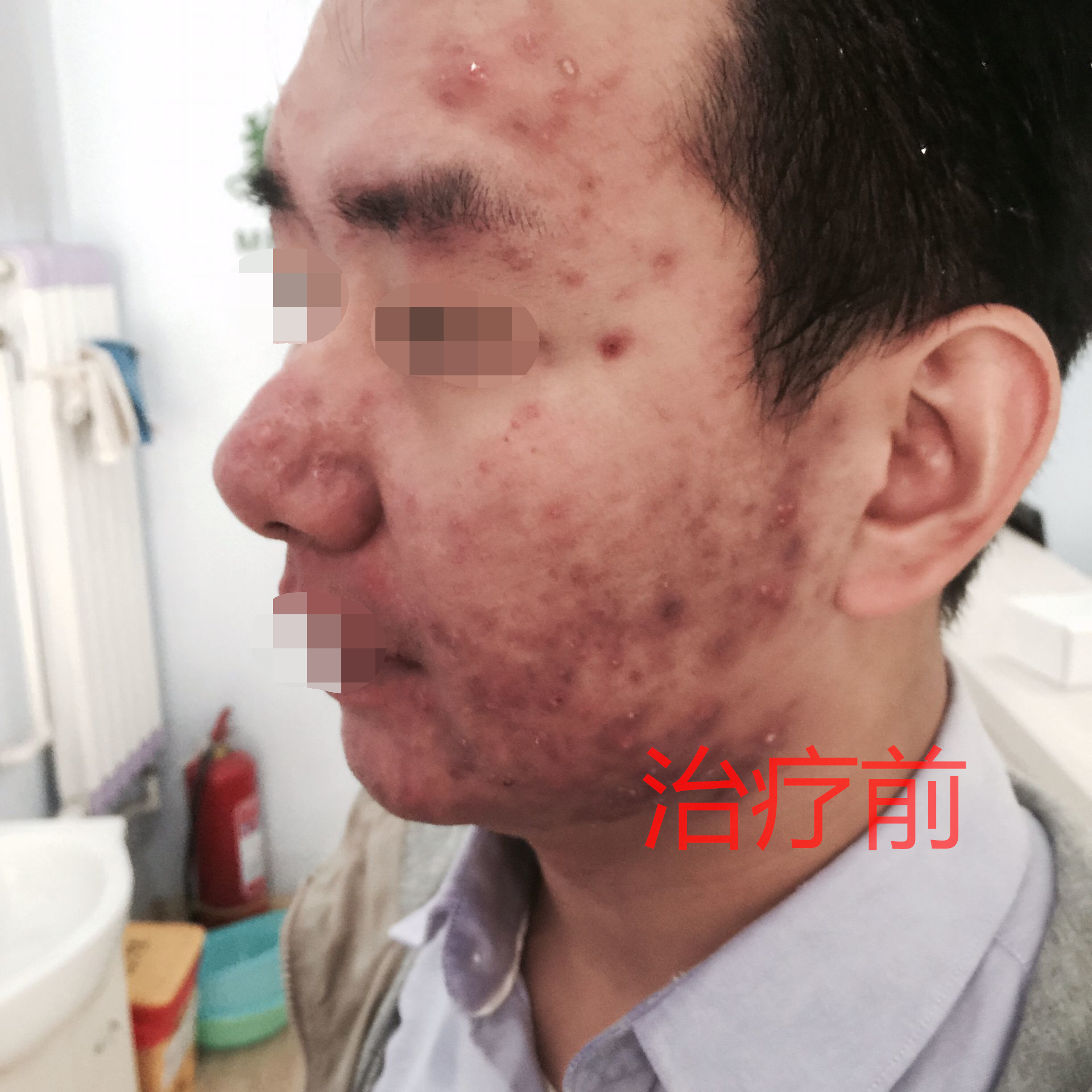 重度痤疮治疗前后对比图