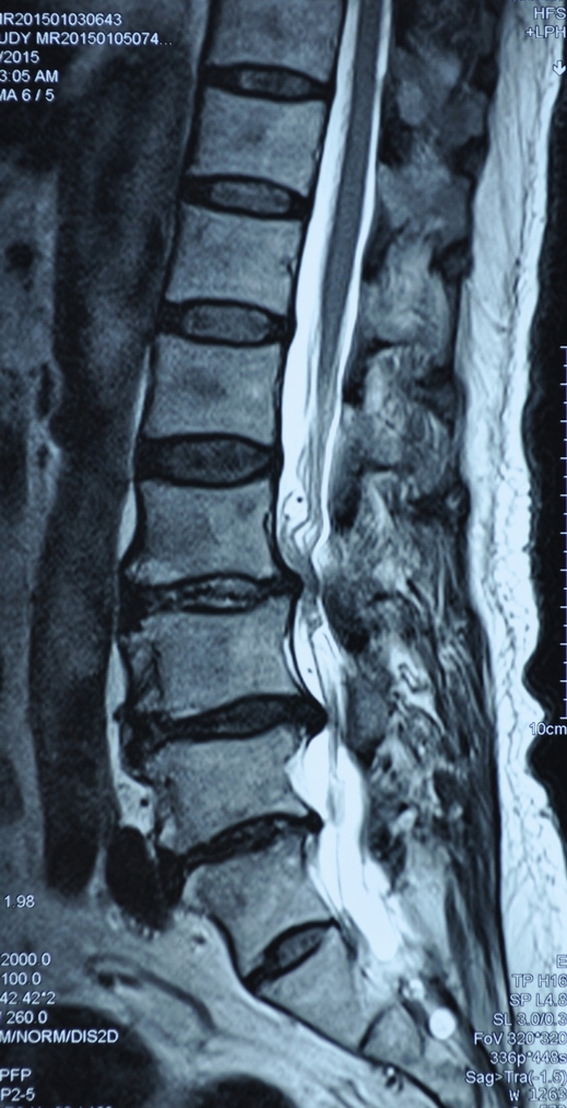 退变性的腰椎手术脊柱融合还是动态固定