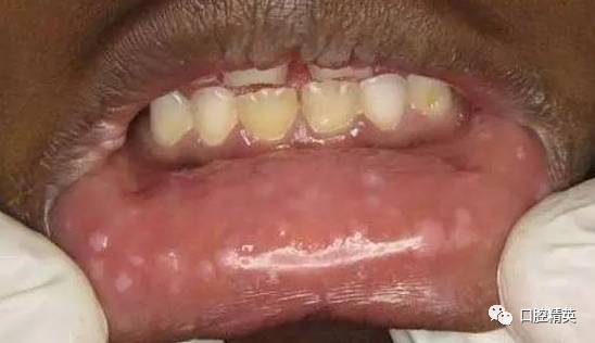 如何通过口腔感染来确诊艾滋病?