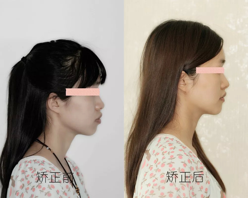凸嘴篇丨牙齿矫正如何提升颜值系列