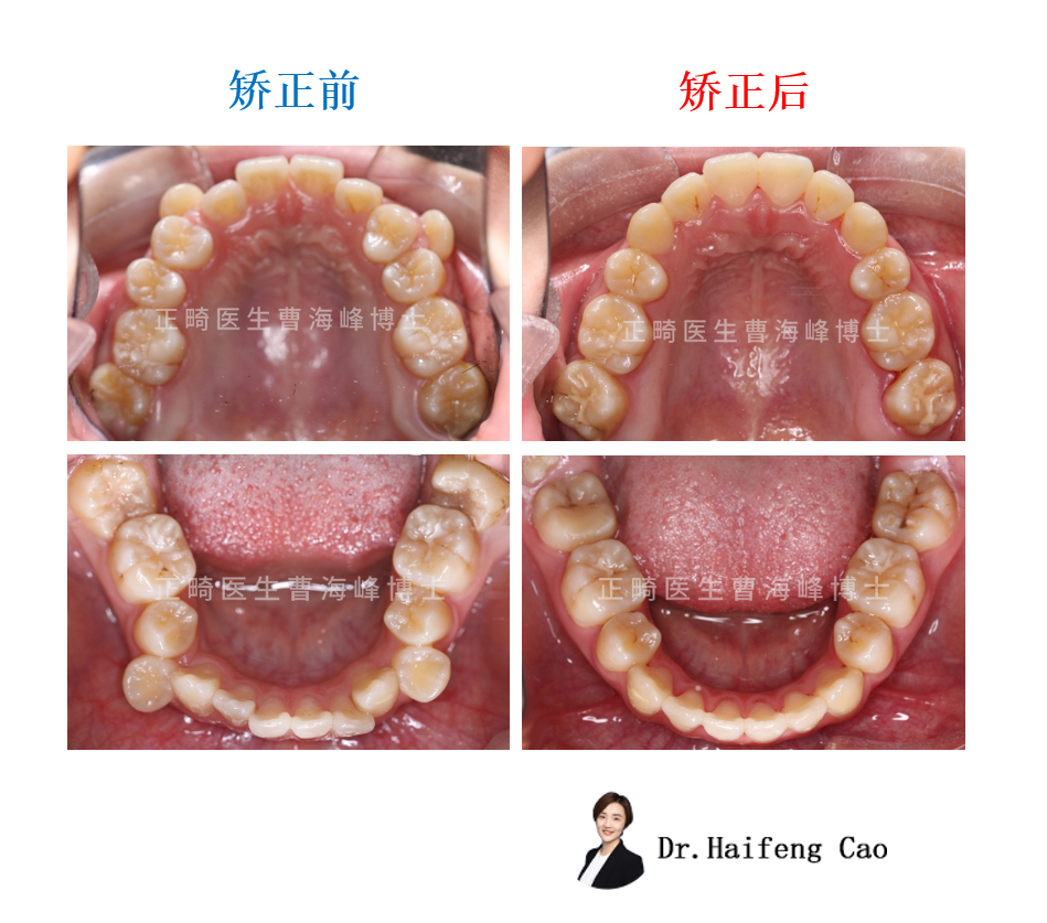 牙齿矫正牙列拥挤图片图片