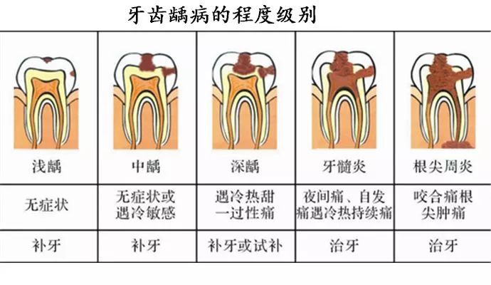 急性根尖周炎(慢性根尖周炎急性发作)症状:牙根下面疼