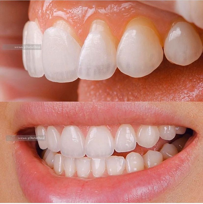 无论是牙齿美白 还是 超薄美学贴片 都是需要找到专业的口腔医生.