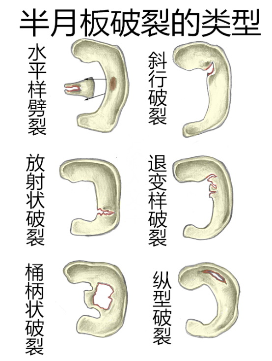 半月板损伤的典型症状:疼痛,膝关节交锁(即卡住感),屈曲,伸直活动范围