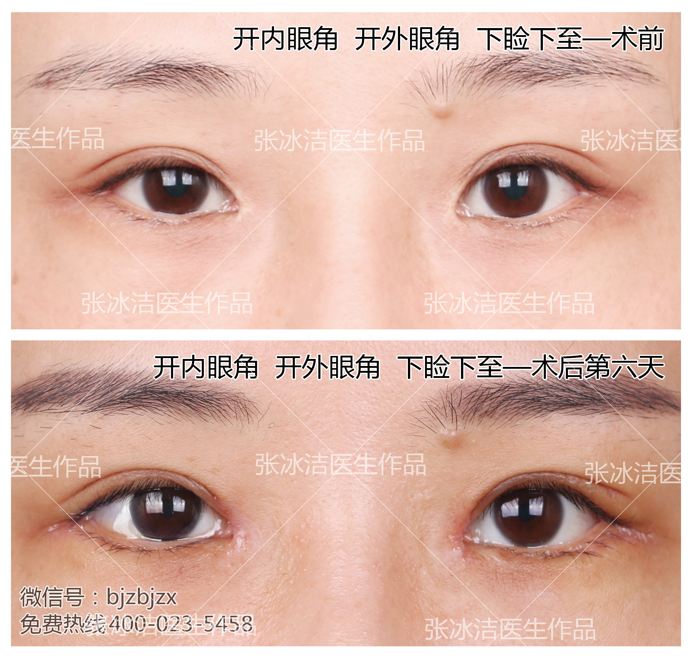 【术前诊断】：眼裂短、眼间距宽、重度内眦赘皮患者，_圈子-新氧美容整形