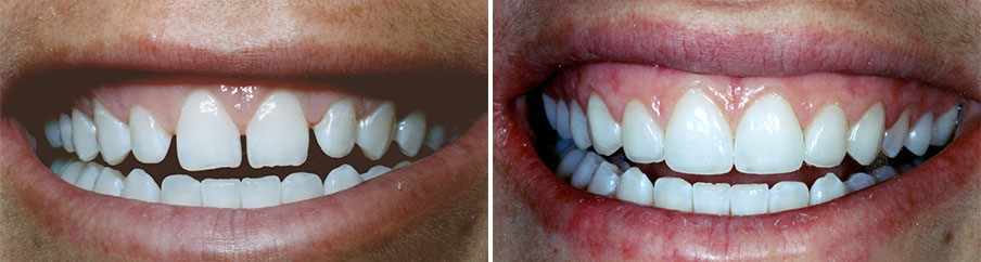 我的牙缝很大,能补吗?