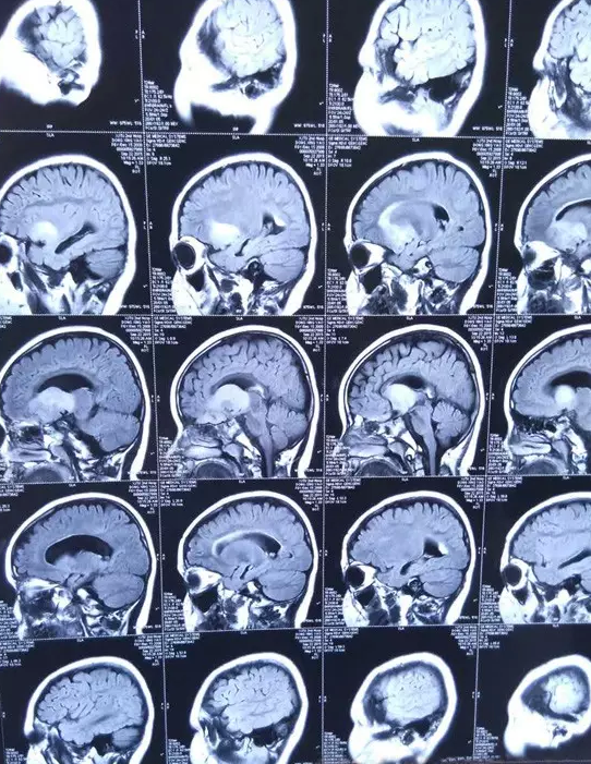 第四軍醫大學唐都醫院神經外科五病區賈棟主任根據影像學資料和婷婷的
