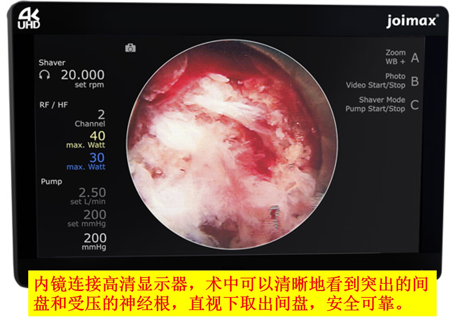 不只是微创椎间孔镜经典病例分享