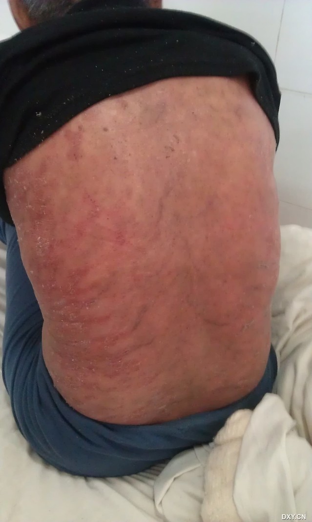 药物过敏!该该不该怪医生?