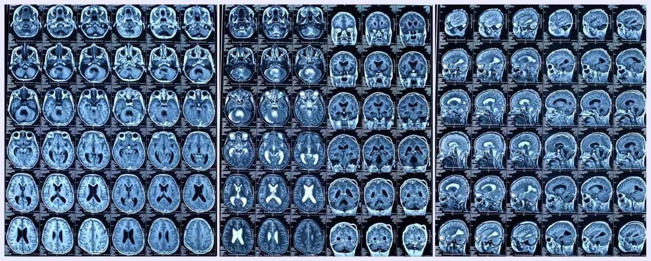 病例:手術治療小兒髓母細胞瘤伴腦積水一例