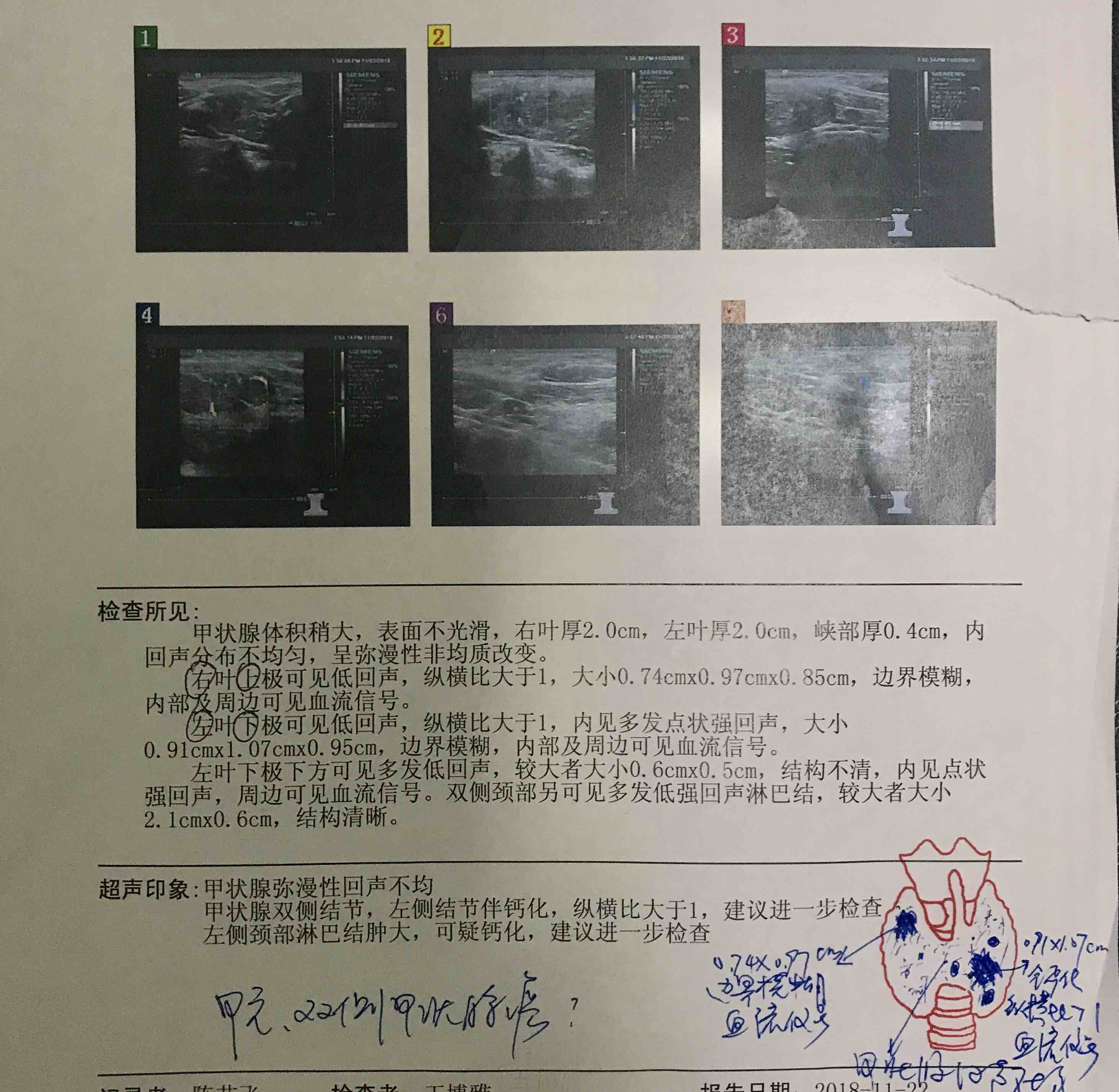 一位甲状腺癌隐藏于桥本氏甲状腺炎伴甲亢患者的诊治经验分享
