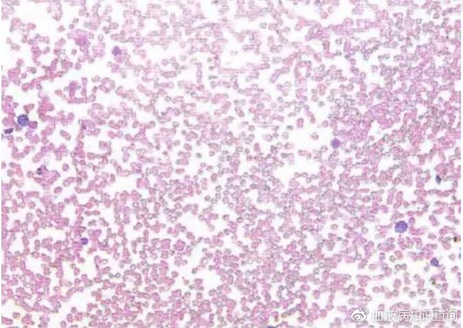再障性贫血的骨髓涂片,你认识吗?