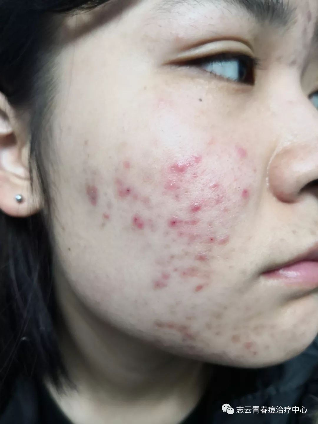 青春痘治疗