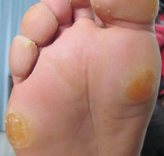 脚上长的是鸡眼?跖疣?还是胼胝?答案全在这了!