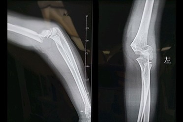 孩子滑滑板车 摔倒就导致胳膊骨折了 这可怎么办 姚京辉副主任医师 爱问医生