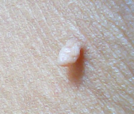 痔疮皮赘是什么样子的图片