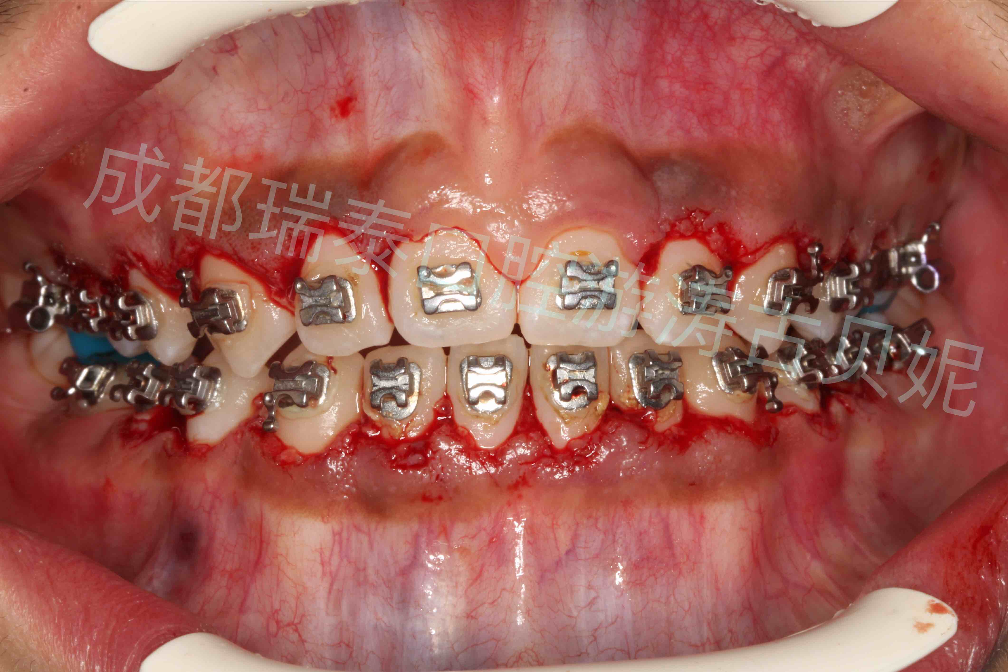 矫正过程中刷牙不当引起牙龈增生的手术实例