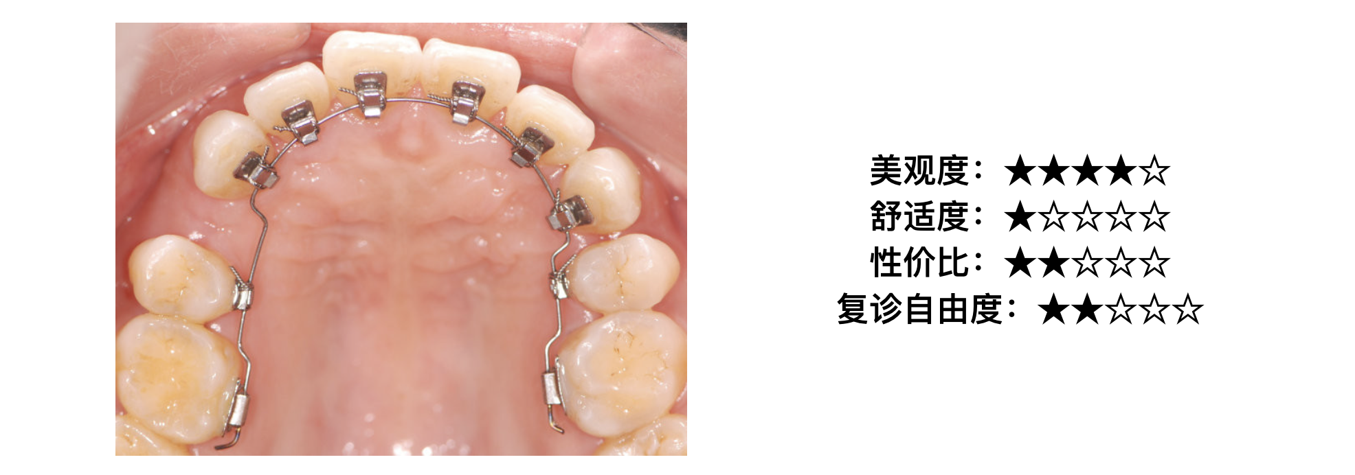 你对矫正器足够了解吗?