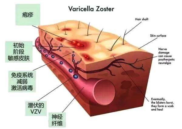 盤蛇瘡纏腰龍皮膚針刺樣疼痛帶狀皰疹應該如何治療