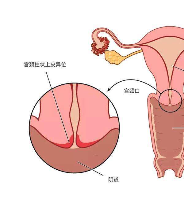 怀孕后宫颈口变化图图片