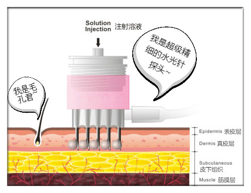 水光針可將透明質酸,膠原蛋白,細胞生長因子等物質,注入到真皮層,起到