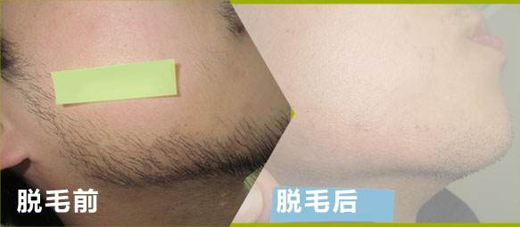 美丽蜕变之激光脱毛篇