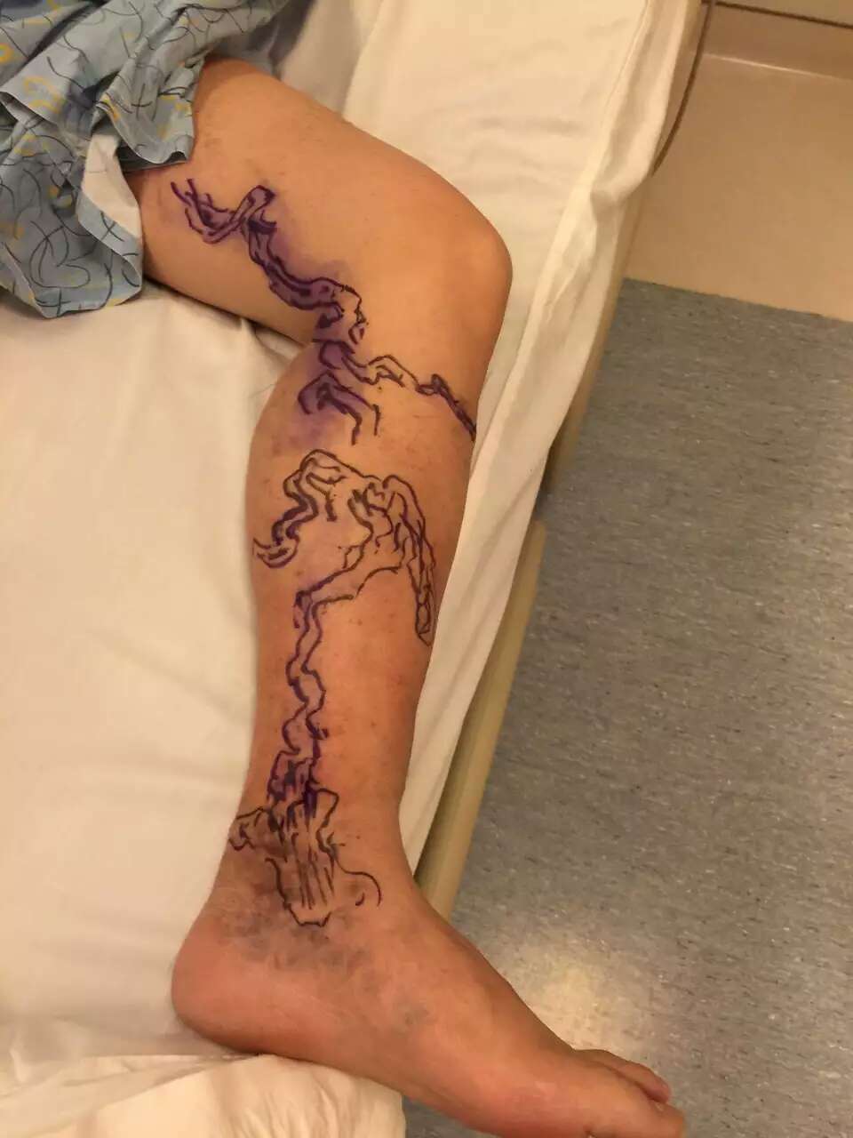 此处血管壁本来就薄,承受力弱,但不得不承担高压,出问题的比例自然就