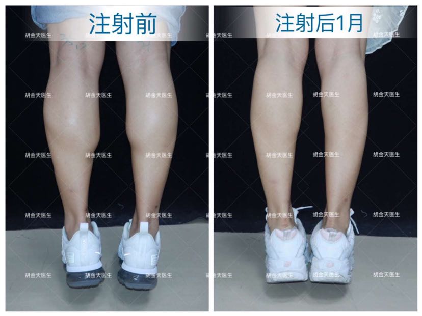 肉毒素瘦小腿,是什么原理?