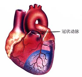 冠状动脉搭桥手术是怎么回事