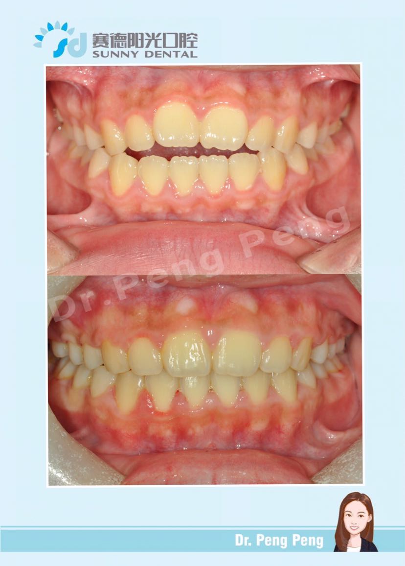 未成年前牙开合病例-彭鹏主治医师-爱问医生
