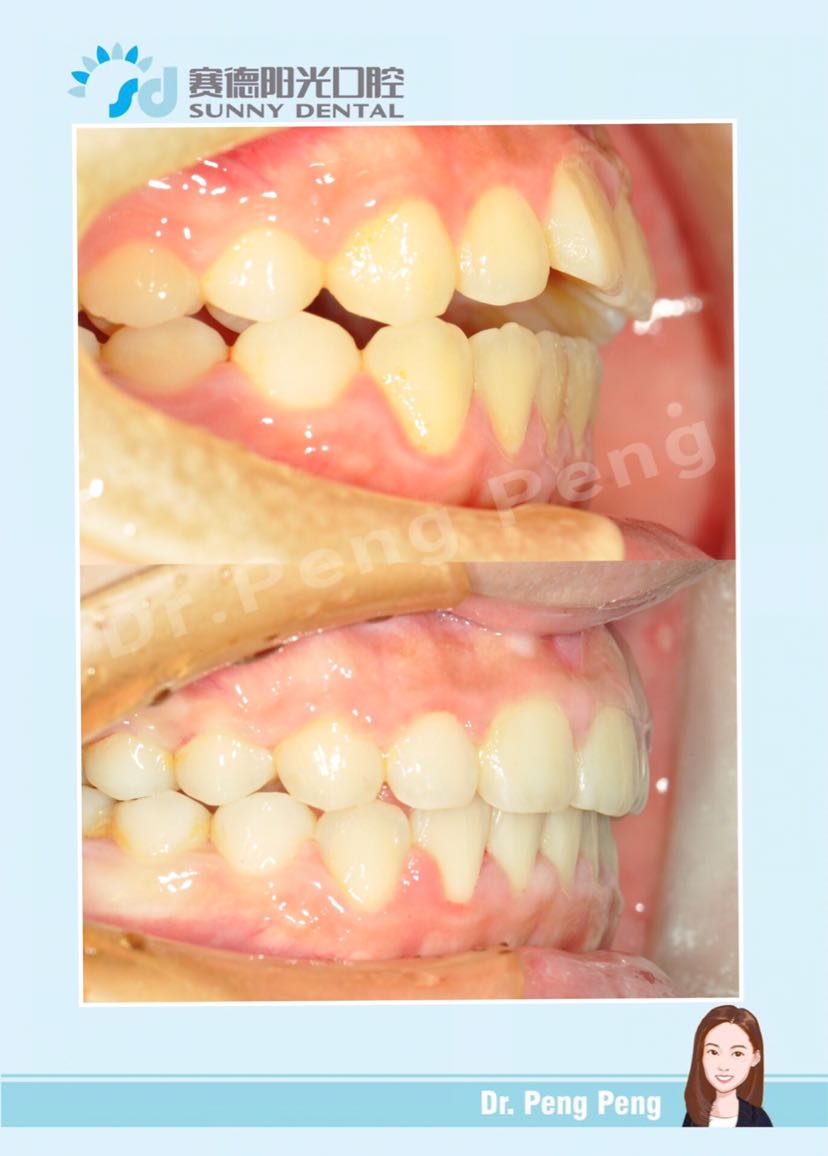 未成年前牙开合病例