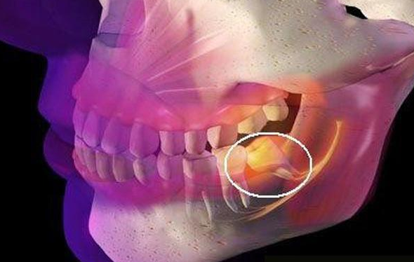 智齿,是我们口腔内的第三颗磨牙,它是生长在牙槽骨的最里面的那颗牙齿