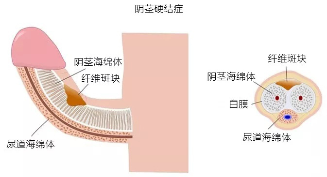 丁丁为什么会弯曲,会影响勃起吗?