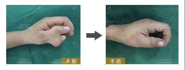 多指畸形,六指畸形,并指畸形_大山谷图库