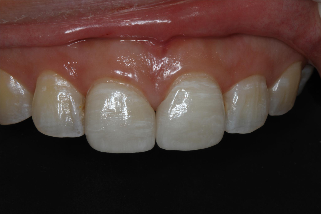 关于【全瓷贴面】修复牙齿间隙的案例